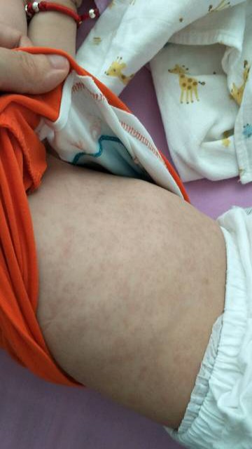 为什么会出现母乳性黄疸：为什么会出现母乳性黄疸的原因